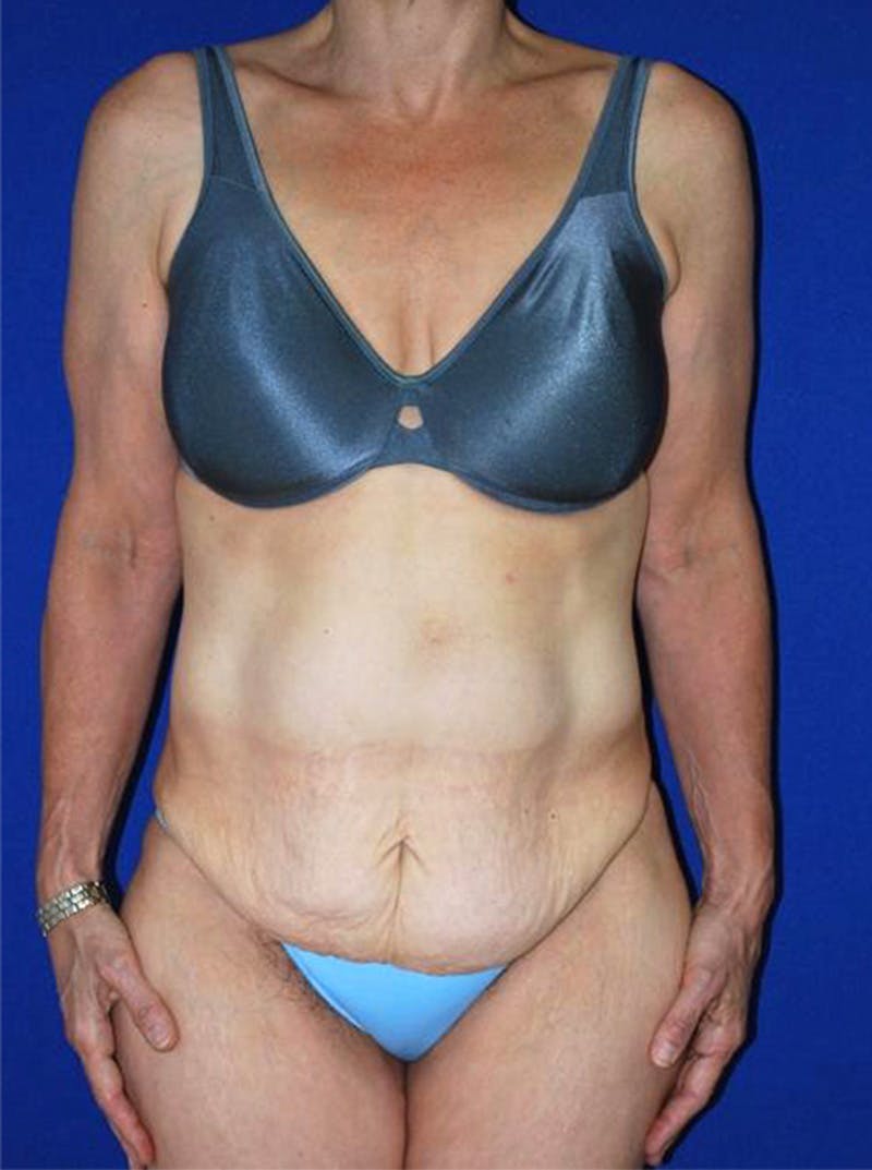 Abdominoplasty Before & After Gallery - Patient 175169149 - Image 3