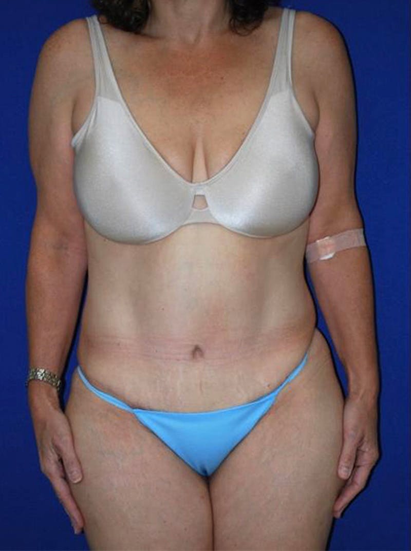 Abdominoplasty Before & After Gallery - Patient 175169149 - Image 4