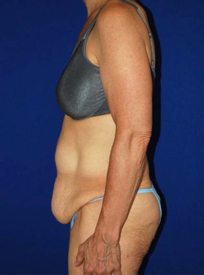 Abdominoplasty Before & After Gallery - Patient 175169149 - Image 1