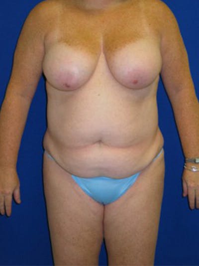 Abdominoplasty Before & After Gallery - Patient 175169452 - Image 1