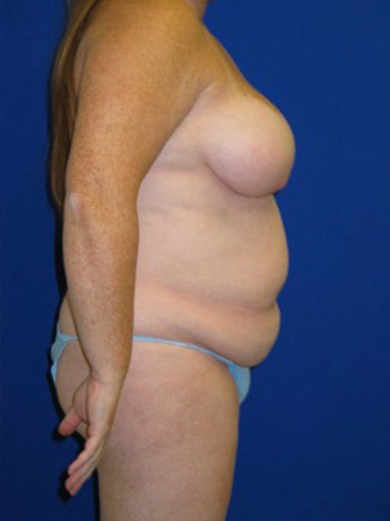 Abdominoplasty Before & After Gallery - Patient 175169452 - Image 3