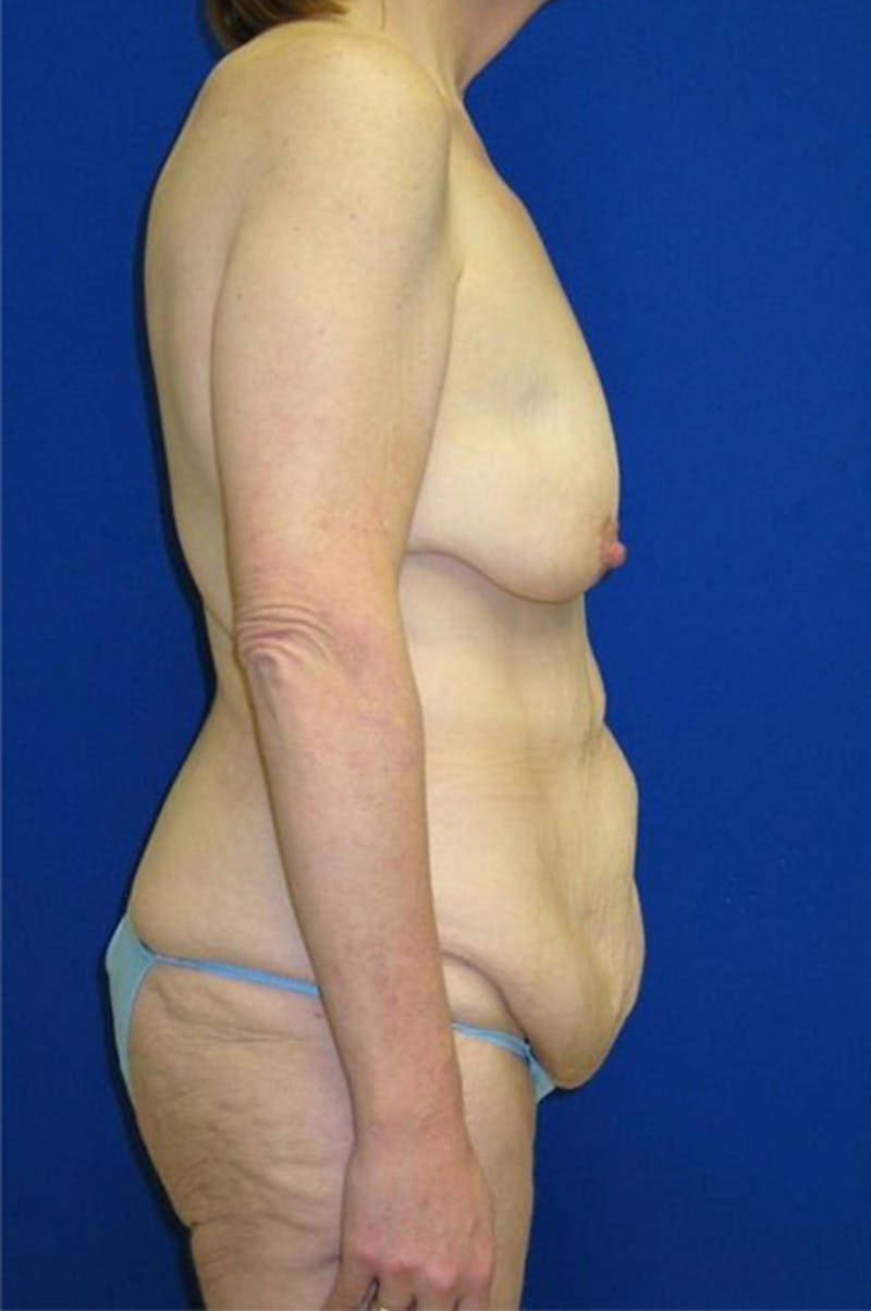 Extended Abdominoplasty Before & After Gallery - Patient 175169300 - Image 3