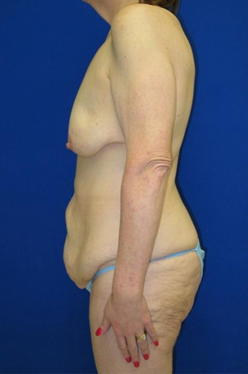 Extended Abdominoplasty Before & After Gallery - Patient 175169300 - Image 5