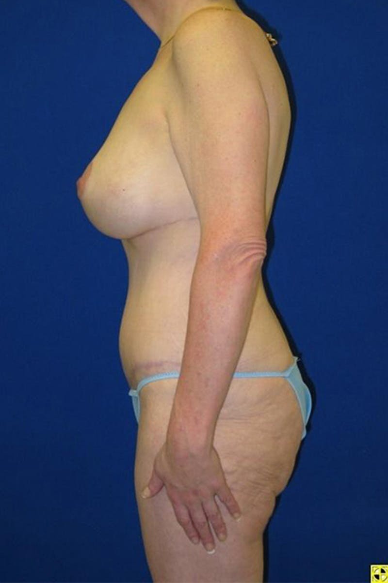 Extended Abdominoplasty Before & After Gallery - Patient 175169300 - Image 6