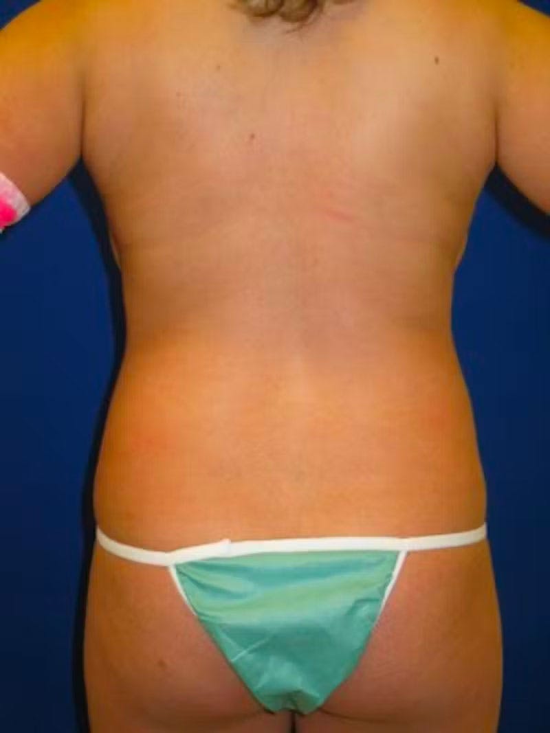 Liposuction Before & After Gallery - Patient 175169018 - Image 7