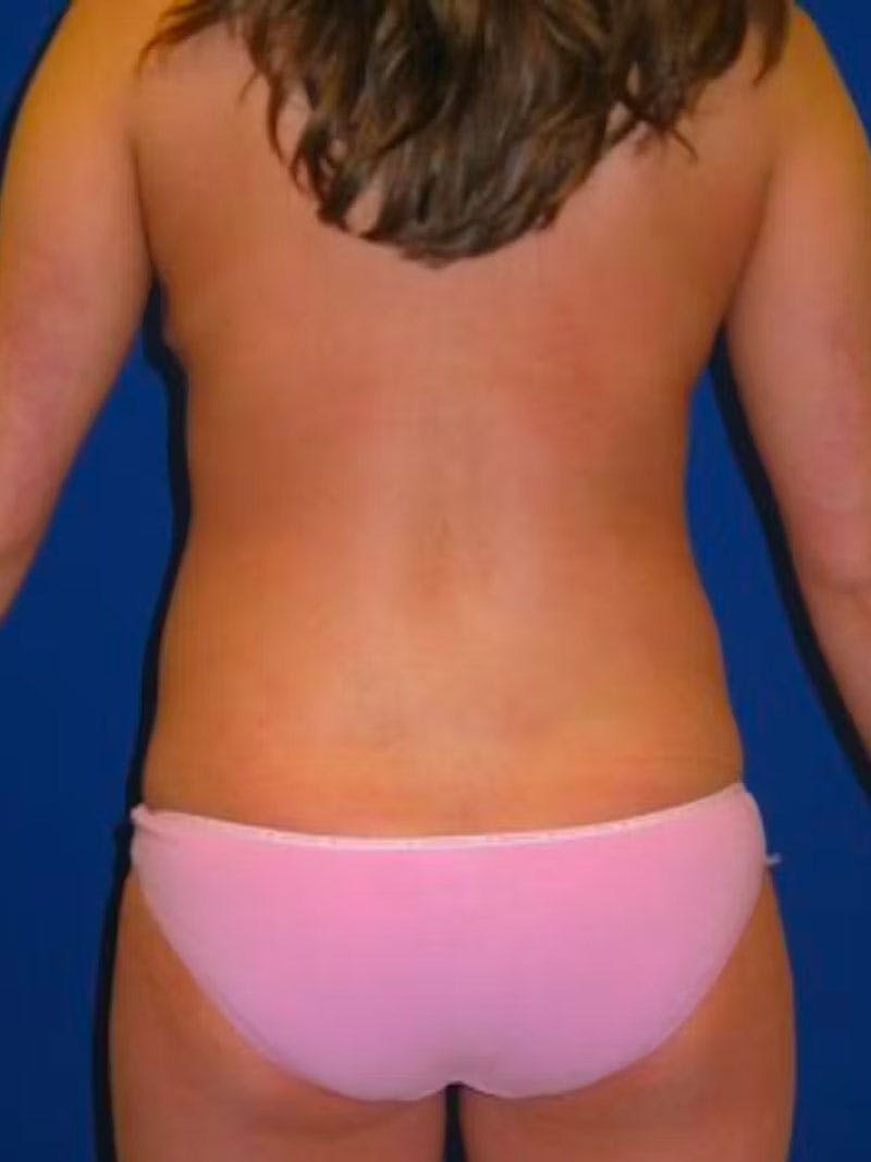 Liposuction Before & After Gallery - Patient 175169018 - Image 8
