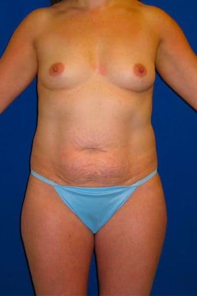 Liposuction Before & After Gallery - Patient 175169088 - Image 1