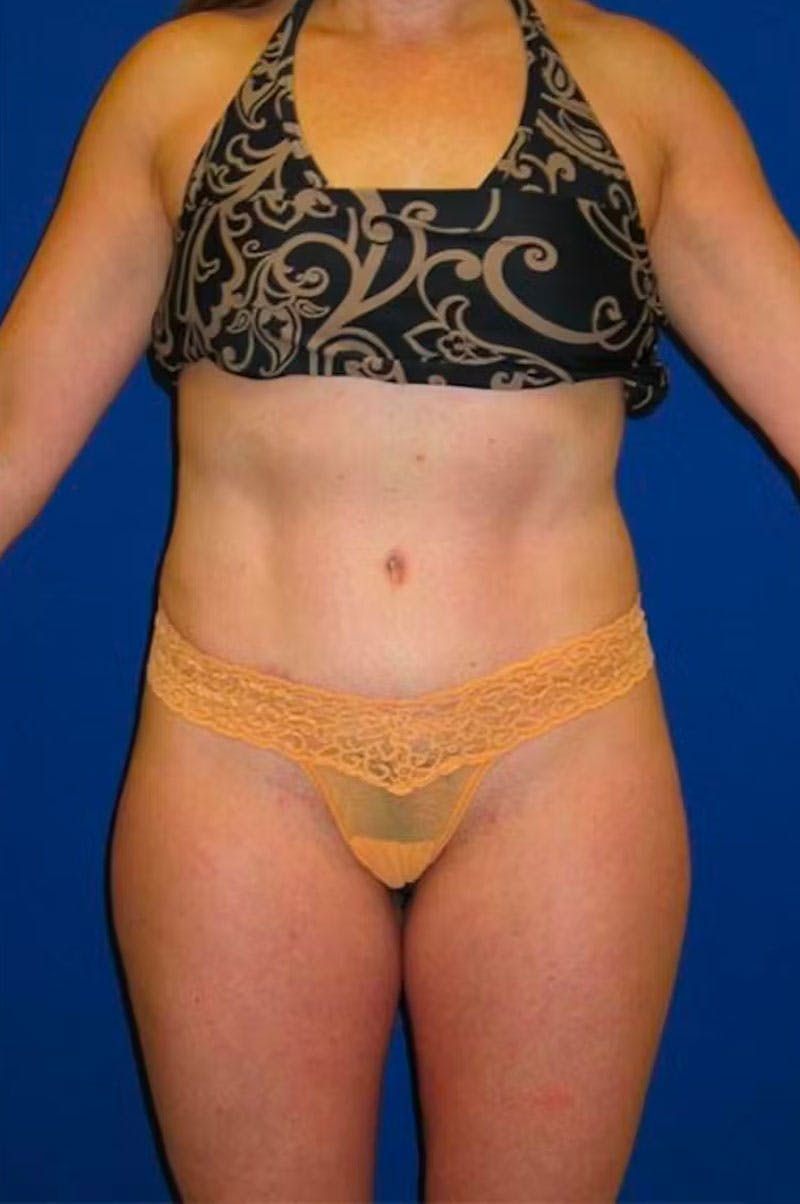 Liposuction Before & After Gallery - Patient 175169088 - Image 2