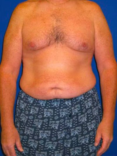 Liposuction Before & After Gallery - Patient 175169262 - Image 1
