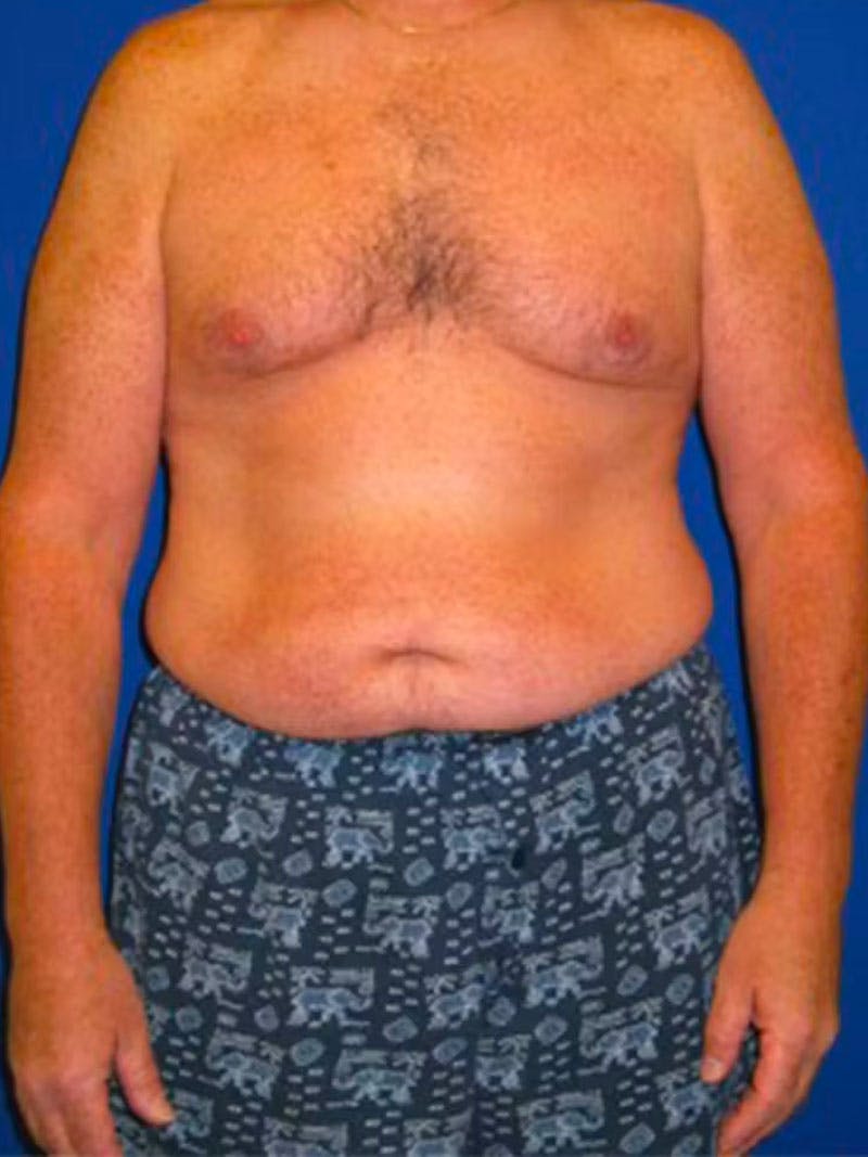 Liposuction Before & After Gallery - Patient 175169262 - Image 1