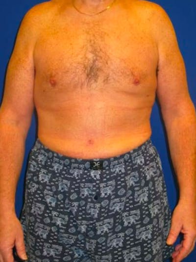 Liposuction Before & After Gallery - Patient 175169262 - Image 2