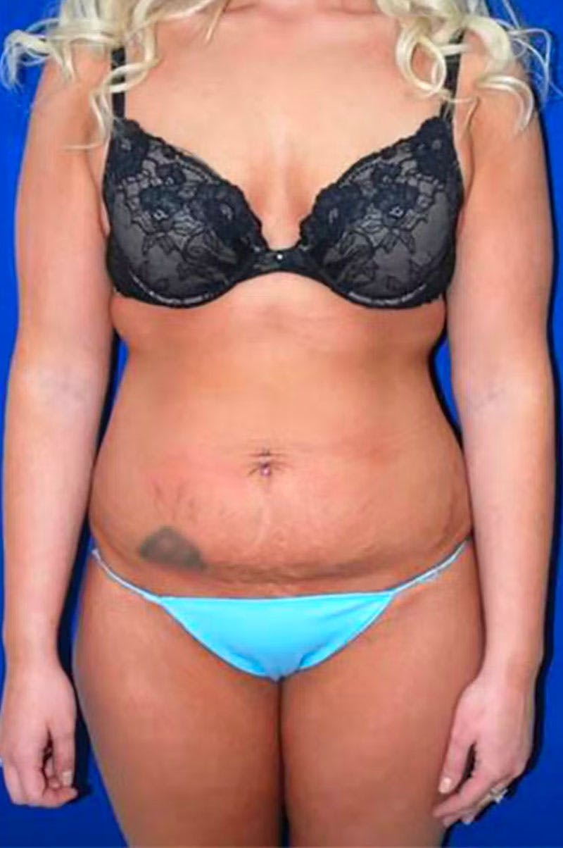 Extended Abdominoplasty Before & After Gallery - Patient 178915912 - Image 1