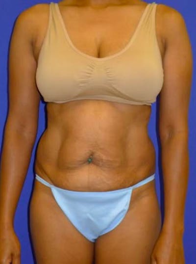 Abdominoplasty Before & After Gallery - Patient 175169457 - Image 1