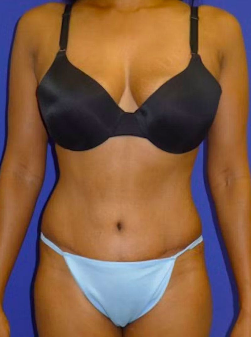 Abdominoplasty Before & After Gallery - Patient 175169457 - Image 2