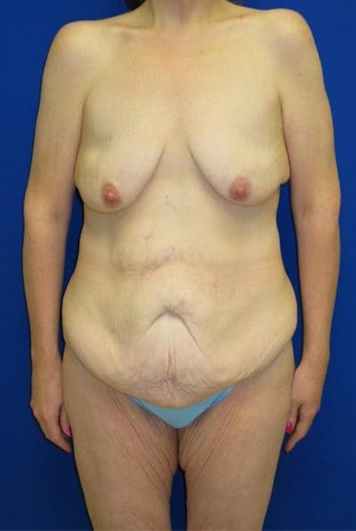 Panniculectomy Before & After Gallery - Patient 178934954 - Image 1