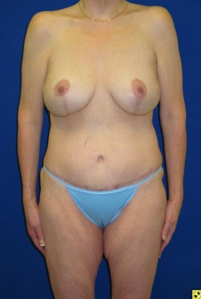 Panniculectomy Before & After Gallery - Patient 178934954 - Image 2