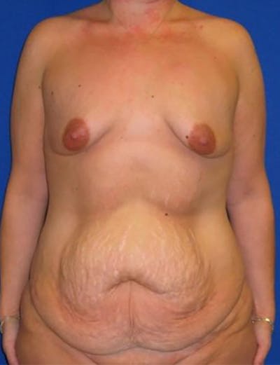 Extended Abdominoplasty Before & After Gallery - Patient 175169319 - Image 1