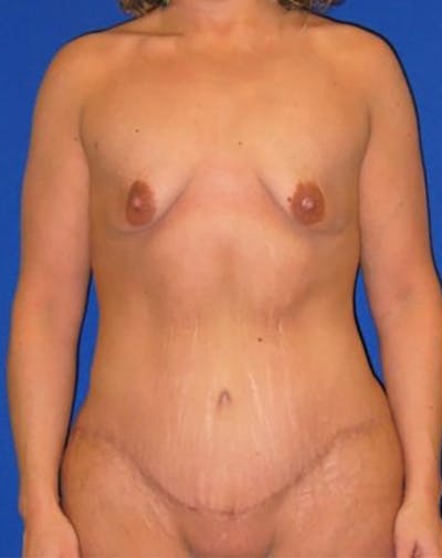 Extended Abdominoplasty Before & After Gallery - Patient 175169319 - Image 2