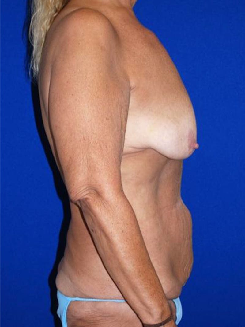 Extended Abdominoplasty Before & After Gallery - Patient 175169357 - Image 7