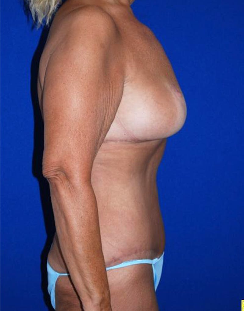 Extended Abdominoplasty Before & After Gallery - Patient 175169357 - Image 8