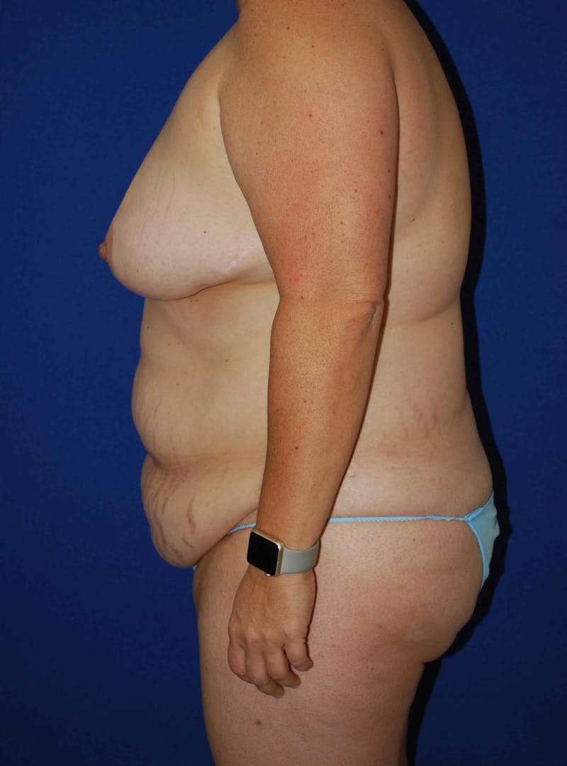 Liposuction Before & After Gallery - Patient 179233632 - Image 5