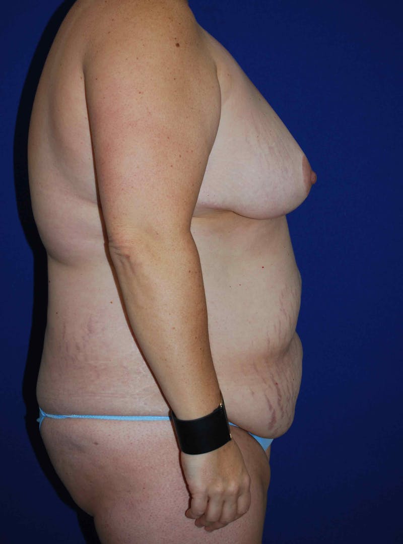 Liposuction Before & After Gallery - Patient 179233632 - Image 7