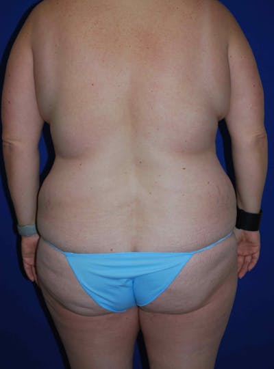 Liposuction Before & After Gallery - Patient 179233632 - Image 1