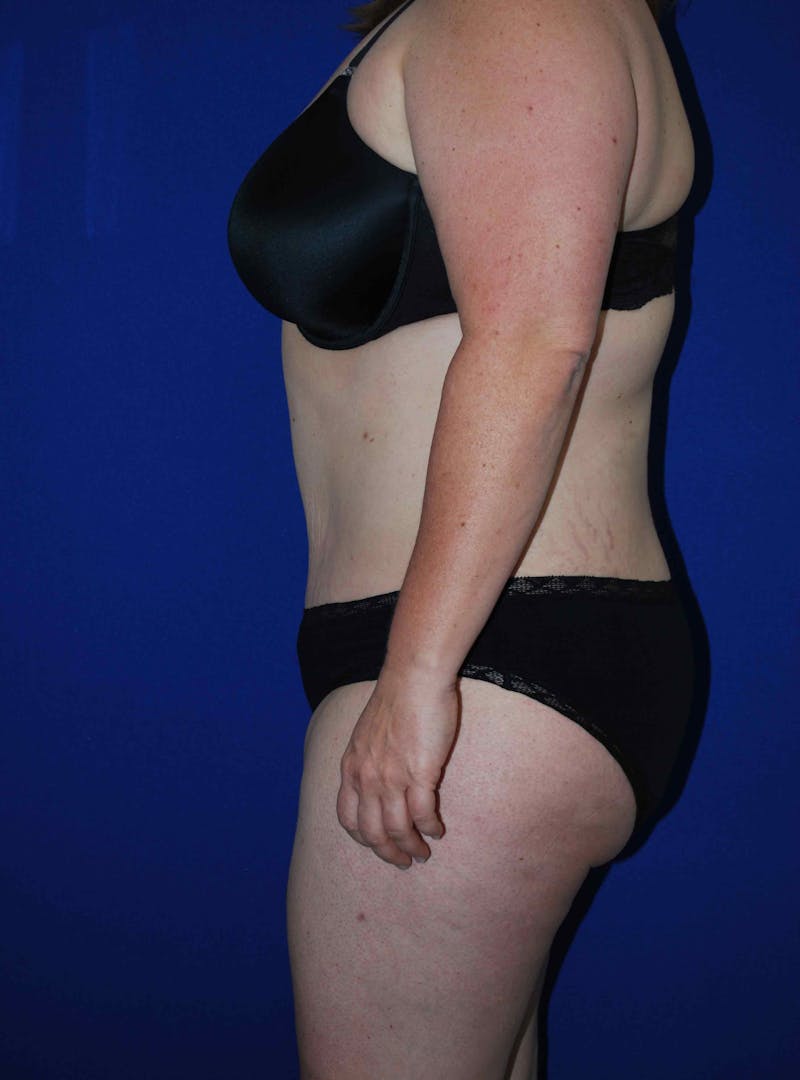 Liposuction Before & After Gallery - Patient 179233632 - Image 6