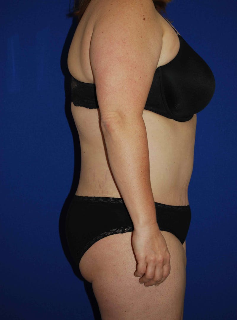 Liposuction Before & After Gallery - Patient 179233632 - Image 8