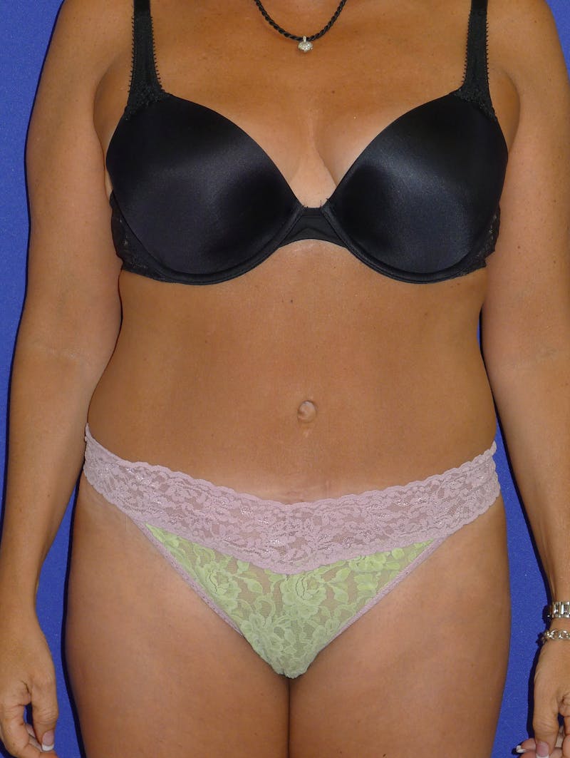 Liposuction Before & After Gallery - Patient 175180754 - Image 14