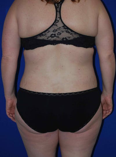 Liposuction Before & After Gallery - Patient 179233632 - Image 2