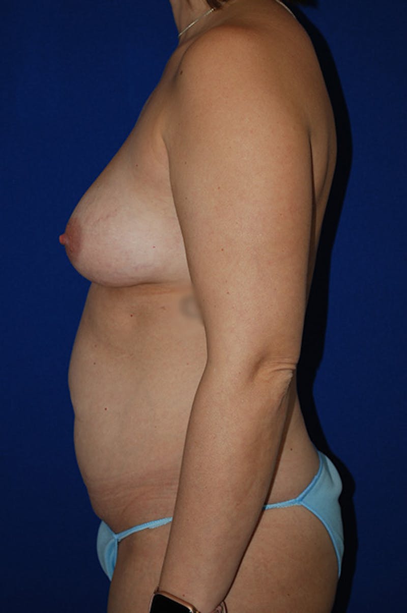 Abdominoplasty Before & After Gallery - Patient 278508 - Image 3