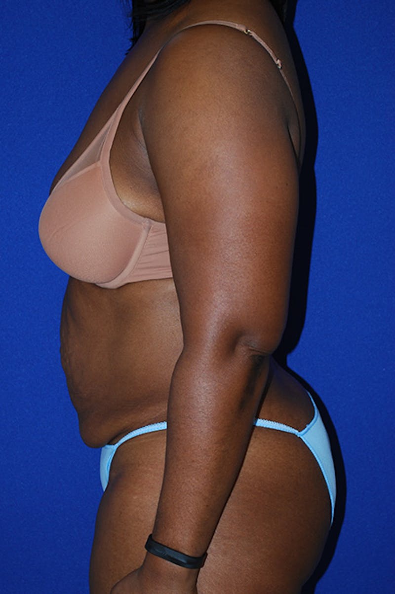 Abdominoplasty Before & After Gallery - Patient 364621 - Image 3