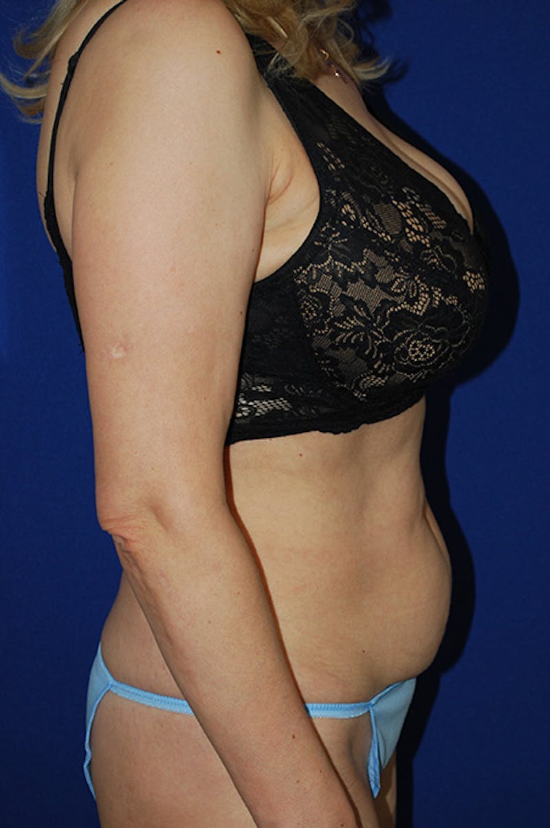 Abdominoplasty Before & After Gallery - Patient 310902 - Image 3
