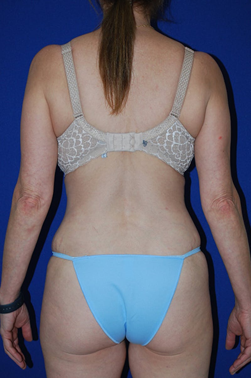 Abdominoplasty Before & After Gallery - Patient 364621 - Image 6