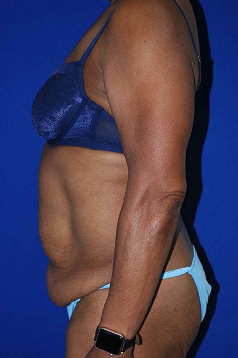 Abdominoplasty Before & After Gallery - Patient 320975 - Image 3