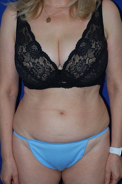 Abdominoplasty Before & After Gallery - Patient 310902 - Image 1