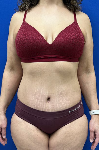 Abdominoplasty Before & After Gallery - Patient 155978 - Image 2