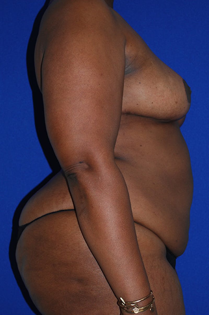 Abdominoplasty Before & After Gallery - Patient 341849 - Image 3