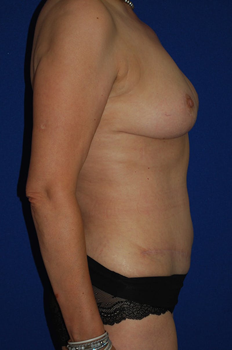 Abdominoplasty Before & After Gallery - Patient 310902 - Image 4