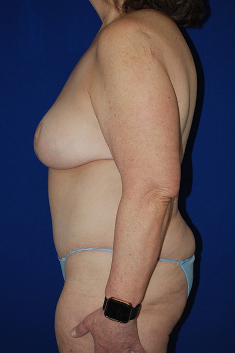 Abdominoplasty Before & After Gallery - Patient 417959 - Image 6