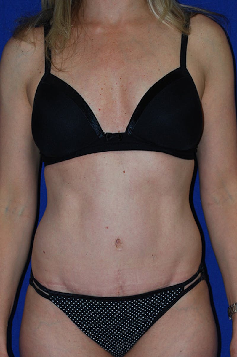 Abdominoplasty Before & After Gallery - Patient 227946 - Image 2