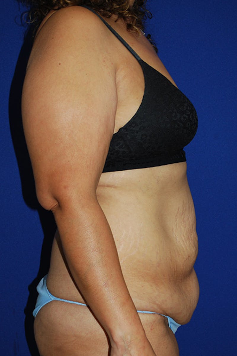 Abdominoplasty Before & After Gallery - Patient 155978 - Image 3