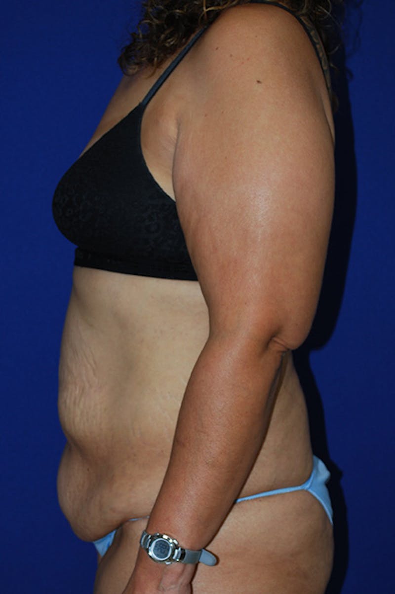 Abdominoplasty Before & After Gallery - Patient 155978 - Image 5
