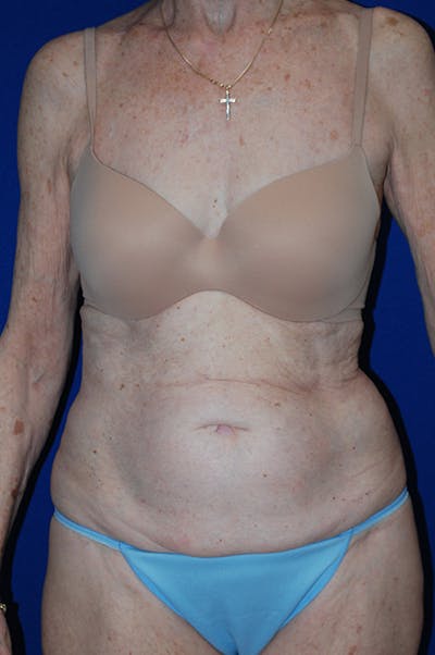 Abdominoplasty Before & After Gallery - Patient 316063 - Image 1