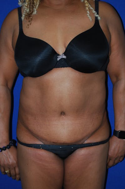 Abdominoplasty Before & After Gallery - Patient 320975 - Image 2