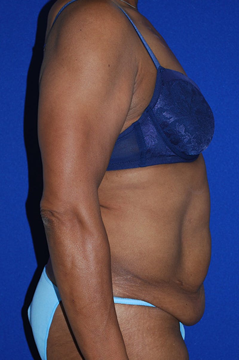 Abdominoplasty Before & After Gallery - Patient 320975 - Image 5