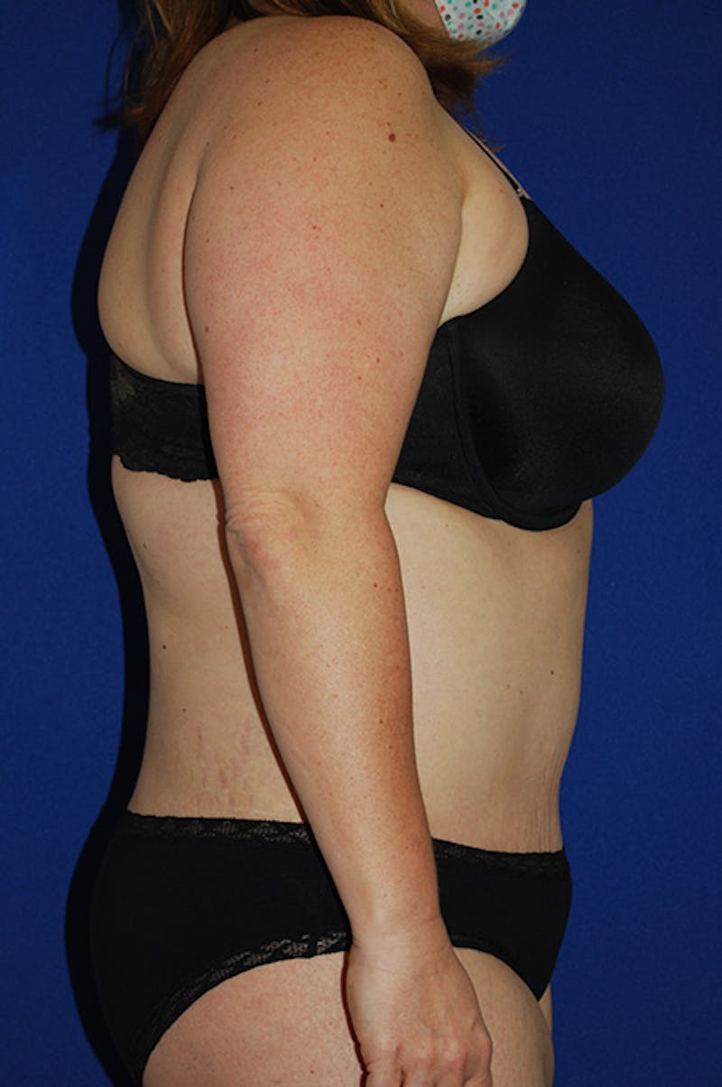 Abdominoplasty Before & After Gallery - Patient 869180 - Image 4