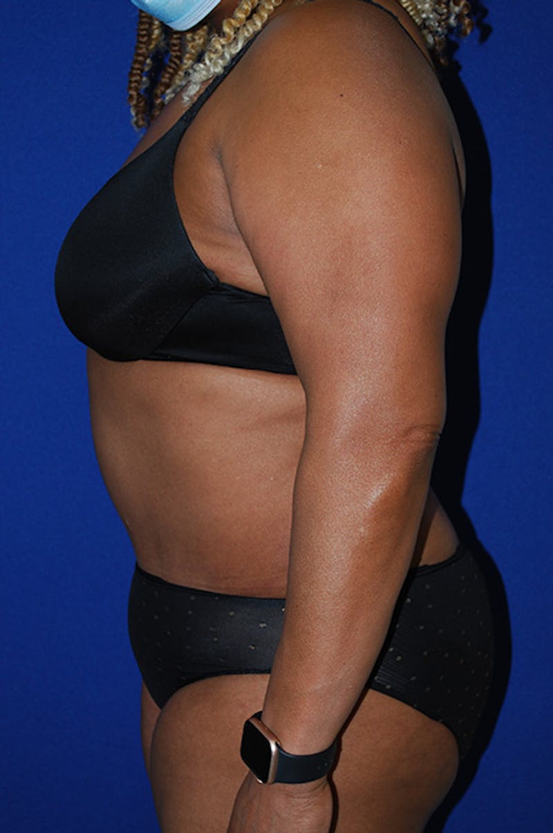 Abdominoplasty Before & After Gallery - Patient 320975 - Image 4