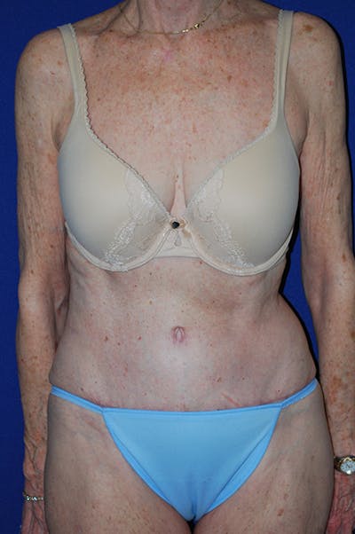 Abdominoplasty Before & After Gallery - Patient 316063 - Image 2
